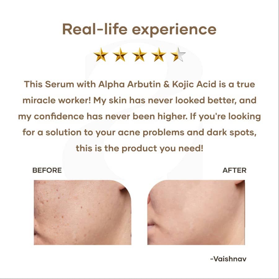 Anti Acne Serum with Alpha Arbutin & Kojic Acid - Image 5