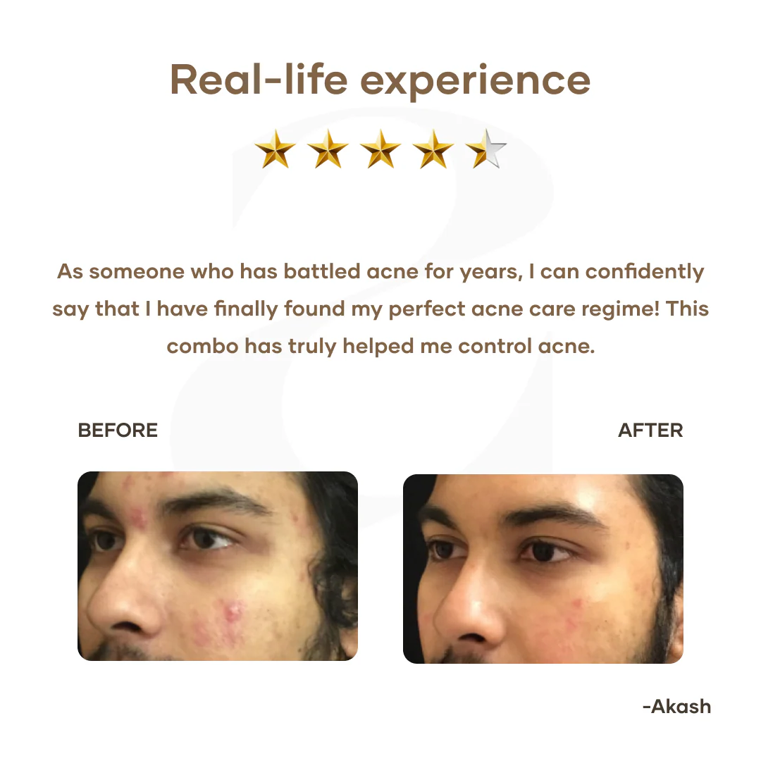 Mars Ultimate Acne Care Regime - Image 4